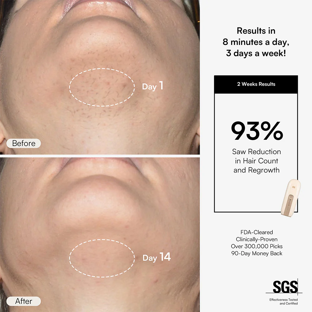 INIA FOND IPL Hair Removal Device - Image 5
