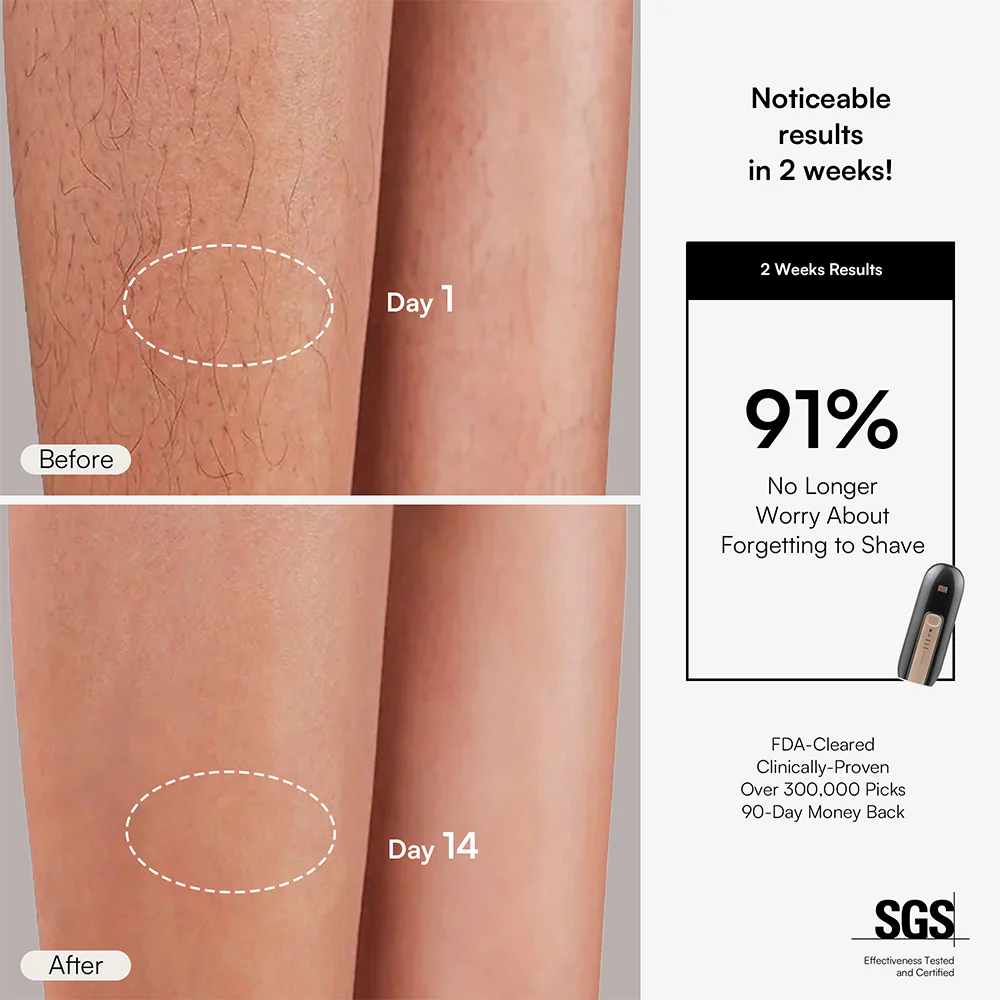 INIA FOND IPL Hair Removal Device - Image 6