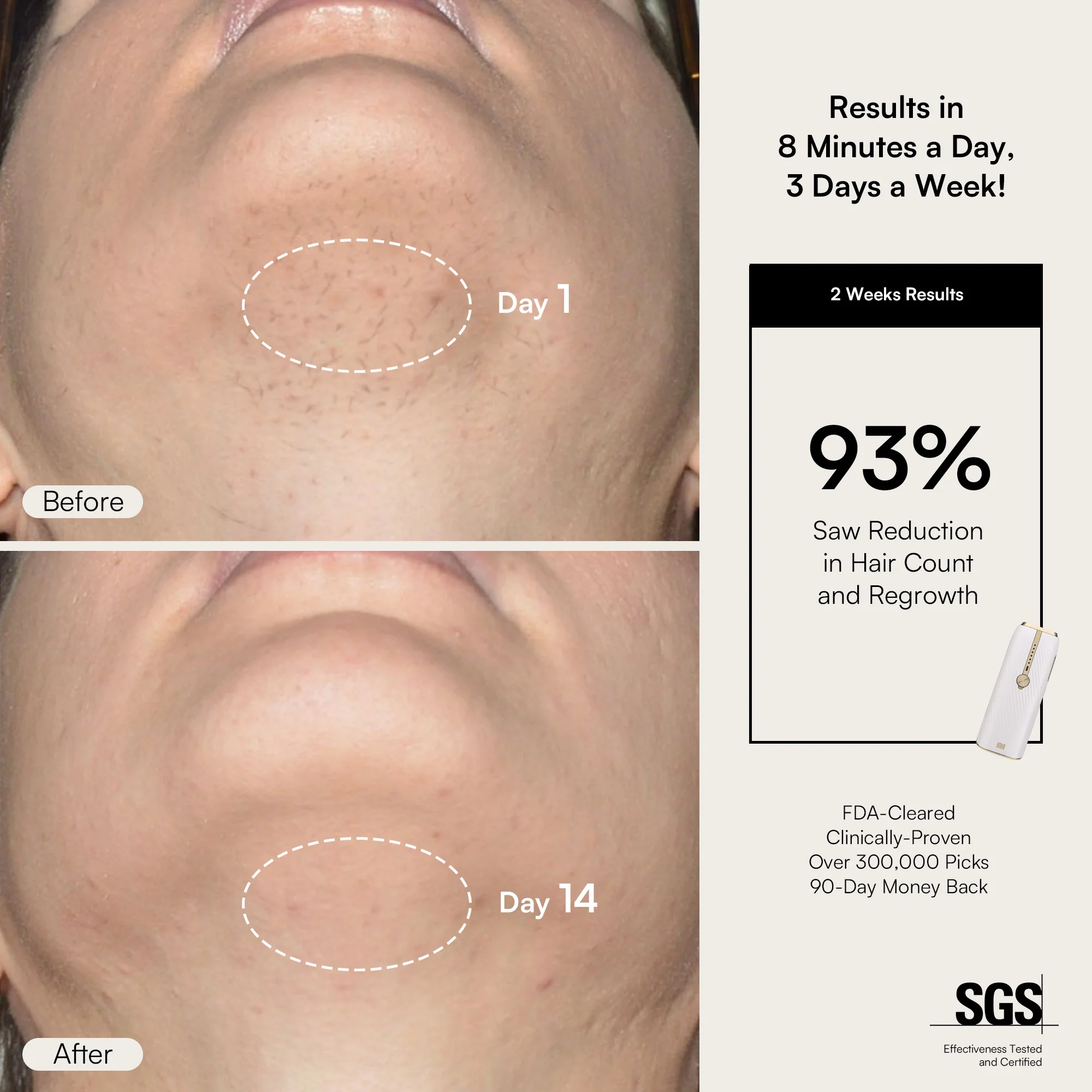 INIA HAUTE IPL Laser Hair Removal Device - Image 5